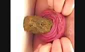 Anal prolapse after pooping
